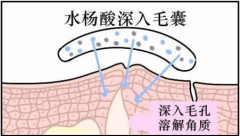 毛孔粗大的雷区，你中了几个？